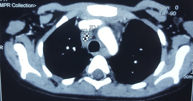 Nijmegen breakage syndrome: case report and review of literature - PMC