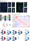 Figure 6. Spatial transcriptomics reveals a unique epithelial gene signature of PanIN lesions that aligns closely with tumor epithelium. A, Left, GeoMX tissue section from a donor pancreas stained for panCK and CD45. panCK+ segments are pseudocolored in green, whereas panCK−CD45− segments are pseudocolored in red. Right, GeoMX tissue section from surgically resected, treatment-naive PDAC stained for panCK and CD45. panCK+ segments are pseudocolored in purple. B, Sankey plot showing the distribution of ROIs in donor or PDAC samples. C, Heat map of cell type–specific markers derived from differential gene expression using the linear mixed model on spatial transcriptomic ROIs. D, UMAP overlay of disease states on extracted epithelial cells from the single-cell dataset of healthy, adjacent normal, and tumor samples. E, AUCell gene set scoring mapped to the epithelial single-cell dataset of healthy, adjacent normal, and tumor samples using signatures derived from acinar, normal duct, PanIN, and ADM spatial transcriptomic ROIs. The top row represents spatial transcriptomic signatures obtained from healthy tissue; the bottom row represents spatial transcriptomic signatures obtained from tumor tissue. F, AUCell gene set scoring mapped to the epithelial single-cell dataset of healthy, adjacent normal, and tumor samples using signatures derived from glandular tumor and poorly differentiated tumor ROIs.