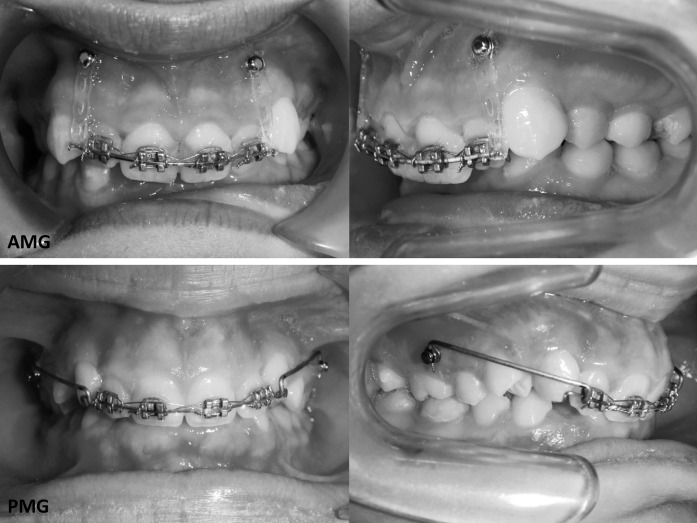 Figure 1. Frontal and lateral views of the intrusive mechanics applied to the AMG and PMG.