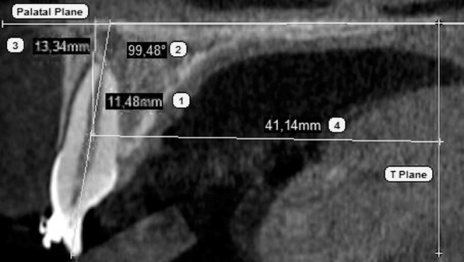 Figure 2. Linear and angular CBCT measurements: (1) 1 length, distance from apex to cementoenamel junction on long axis of the tooth (carried out for all the incisors); (2) 1-PP, angle between long axis of upper central incisor and palatal plane; (3) CR-PP, perpendicular distance from CR of the central incisor to palatal plane; (4) CR-T, perpendicular distance from CR of the central incisor to T plane (plane passing through posterior nasal spine and perpendicular to the palatal plane).