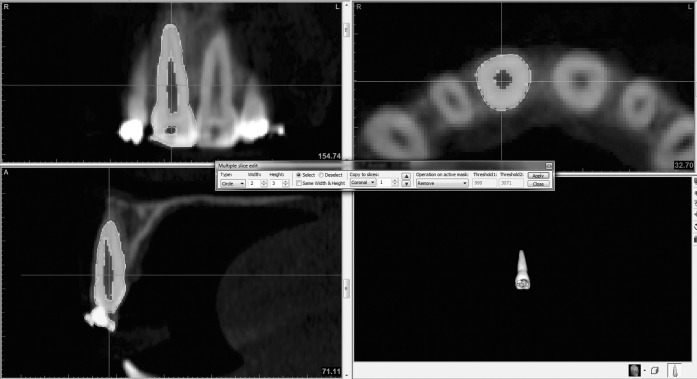 Figure 3. Manual segmentation in axial, coronal, and sagittal slices.