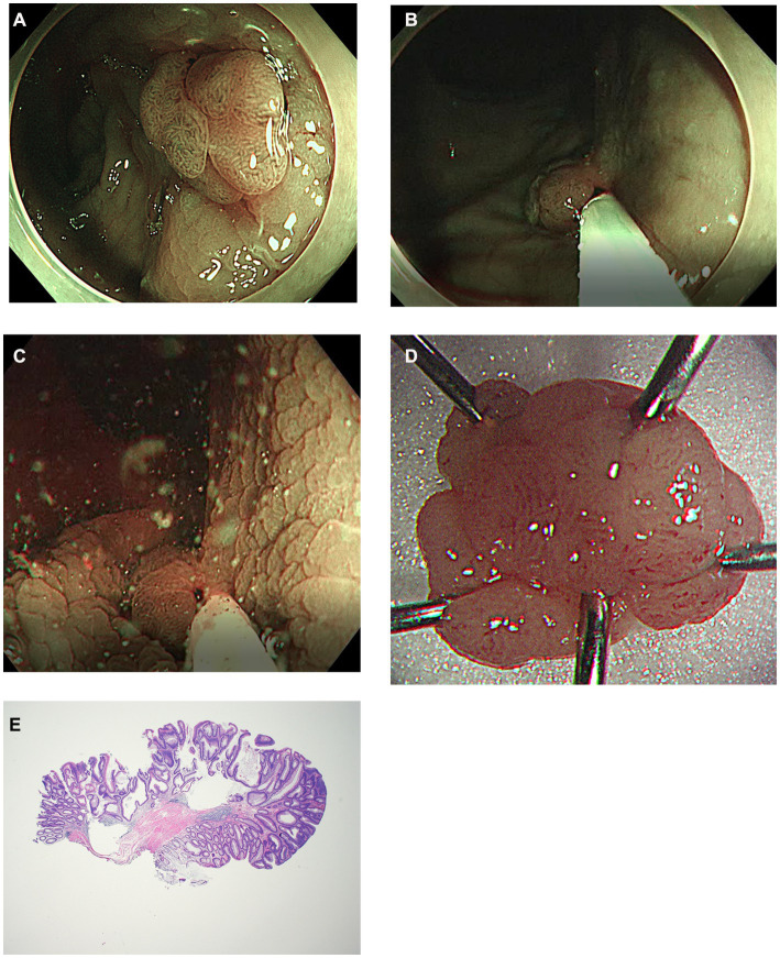 Modified underwater endoscopic mucosal resection for intermediate-sized ...