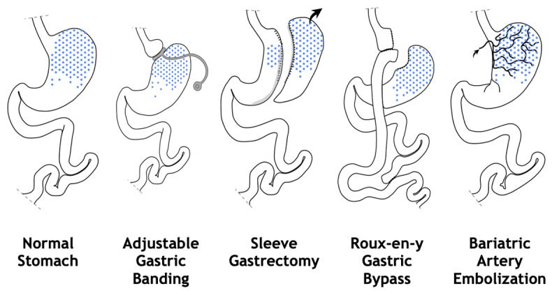 Anatomy and impact of surgery and bariatric embolization of the gastric fundus