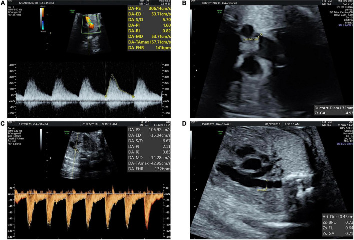 Cardiac Function Assessment in Fetuses With Ductus Arteriosus ...