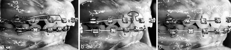 Figure 1. Differential moment approach to space closure. (a) Base archwire with NiTi intrusion arch tied anteriorly mesial to the lateral incisors and NiTi retraction coil spring from first molar to the canine. (b) Mushroom loop used to close space mesial to the canine. (c) Completed space closure at T2.