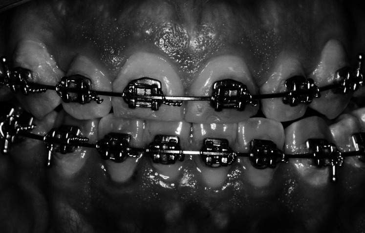 Figure 1. Avex Mx conventional brackets.