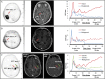 (A) Images in a 63-year-old woman (participant 13) with right
temporoparietal glioblastoma multiforme treated with surgery, followed by
chemotherapy (temozolomide) and radiation therapy. MRI findings are
equivocal for residual disease versus posttreatment change. Static
(4S)-4-(3-[18F]fluoropropyl)-L-glutamate (18F-FSPG) PET image (left) shows
intense uptake in the tumor lesion (arrow), which is visible on the
postcontrast three-dimensional spoiled gradient-echo MRI scan (arrow,
middle). The tumor time-activity curve (TAC) from the dynamic 18F-FSPG PET
images (right) shows a rapidly increasing uptake over time in the
glioblastoma multiforme lesion with an early peak uptake in the first 10
frames. In the background tissue TAC, there is an early peak in the first 10
frames followed by a downward slope and an eventual plateau near zero
activity in the final 28 frames. Subsequent pathologic examination confirmed
the presence of malignant cells. The outcome score for this lesion was a 5.
SUVmax = maximum standardized uptake value. (B) Images in a 44-year-old man
(participant 4) with glioblastoma multiforme in the right temporal lobe
treated with surgery, followed by chemotherapy and repeat resection showing
no tumor. MRI scan (middle) shows an area of contrast enhancement concerning
for progression (arrow). Static 18F-FSPG PET image (left) shows weak uptake
(arrow). The lesion TAC from the dynamic 18F-FSPG PET images (right) shows a
plateau line after an early uptake peak, and higher uptake values in the
tumor lesion at late times when compared to background, with a slight and
slow tendency to increase over time. Subsequent pathologic examination
showed necrosis and reactive changes with no definite glial neoplasm. The
outcome score for this lesion was a 1. (C) Images in a 77-year-old man
(participant 2) with grade III unresectable anaplastic astrocytoma of the
temporal lobe (postradiation therapy). Baseline MRI scan (middle) shows a
lesion with two separate components, one medial (lesion 1, red arrow) and
one lateral (lesion 2, green arrow). Static 18F-FSPG PET image (left) shows
prominent uptake medially (SUVmax = 12), and weak uptake laterally (lesion
SUVmax = 3 on whole body [WB] PET). Follow-up MRI scan (middle) obtained 4
months after baseline shows an increase in size of the medial component,
while the lateral component remains stable. In the background volume of
interest, the TAC on the dynamic 18F-FSPG PET scan (right) shows an
exponential decaying behavior after an early uptake peak. A similar TAC
pattern is seen in the lateral lesion, but with higher uptake values at late
times when compared to the background volume of interest, with a slight and
slow tendency to increase over time. The medial lesion shows rapidly
increasing uptake over time throughout the whole duration of the dynamic PET
acquisition. The slight tendency of 18F-FSPG uptake to increase in the
lateral (nonenhancing) component of the tumor, and the mild uptake on the WB
late scan (SUVmax = 3), suggests a “wait and watch” approach
would be best for this lesion. Mild uptake indicates uptake slightly higher
than surrounding background (healthy tissue). The outcome score for both
lesions in this patient was a 4.