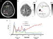 Images in a 65-year-old woman (participant 3) with non–small
cell lung cancer brain metastases. (A) Contrast-enhanced MRI scan shows a
small right frontal lesion (lesion 1, green arrow) and also an enhancing
lesion within the right central sulcus (lesion 2, red arrow), which may
represent evolving treatment effects or progression. (B) Fluorine 18
fluorodeoxyglucose PET image shows no uptake in either lesion, whereas (C)
(4S)-4-(3-[18F]fluoropropyl)-L-glutamate (18F-FSPG) PET image shows mild
uptake in the smaller anterior lesion and intense uptake in the bigger
posterior lesion. (D) Tissue time-activity curves from the dynamic 18F-FSPG
PET images show a plateau line after an early uptake peak in the background
volume of interest, and a similar pattern in the small right frontal lesion
(lesion 1), whereas the larger lesion in the right central sulcus (lesion 2)
shows rapidly increasing uptake over time throughout the whole duration of
the dynamic acquisition. The outcome score was 1 for lesion 1 and 2 for
lesion 2. SUV = standardized uptake value, SUVmax = maximum SUV.