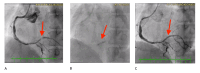 Angiogram showing ISR treated with drug-coated balloon