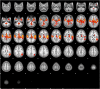 FIGURE 2. Group mean activation map for the story listening task. Group mean BOLD fMRI activation map (stories > tones) in 3- to 5-year-old children (N = 19). All voxels significant at P < .05 (FDR corrected), slice thickness 5 mm for contiguous slices. Slices range from z = –28 to z = 74 in MNI coordinate space. Color scale ranges from t = 1.25 (cooler) to 4 (hotter). Radiologic orientation, left = right, right = left.