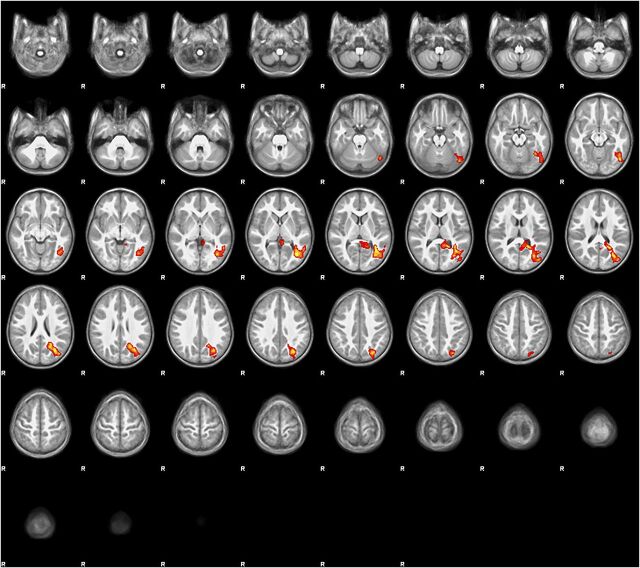 FIGURE 3. Regression map (stories > tones activation) with StimQ-P Reading subscale score as explanatory variable. Regression map for the story listening task (stories > tones) in 3- to 5-year-old children (N = 19), with StimQ-P Reading score as explanatory variable. Cluster size 4087 voxels significant at P < .05 (FDR corrected), z score local maxima 3.25 to 3.44. Five-millimeter slices from z = –28 to z = 74 in MNI coordinate space. Color scale from t = 1.25 (cooler) to 4 (hotter). Radiologic orientation, left = right, right = left.