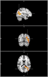 FIGURE 5. Triplanar view of neural activation (stories > tones) with StimQ-P Reading subscale score as explanatory variable, controlling for household income. Orthogonal triplanar view (origin x = –34, y = –66, z = 14, MNI coordinate space) of activation for the story listening task (stories > tones), with StimQ-P Reading score as explanatory variable, controlling for household income. Cluster size 2467 voxels significant at P < .05 (FDR corrected). Color scale ranges from t = 1.25 (cooler) to 4 (hotter). All views in radiologic orientation, left = right, right = left, with sagittal plane viewed from the right.