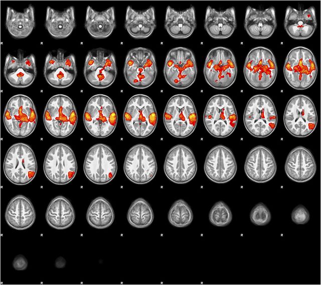 FIGURE 2. Group mean activation map for the story listening task. Group mean BOLD fMRI activation map (stories > tones) in 3- to 5-year-old children (N = 19). All voxels significant at P < .05 (FDR corrected), slice thickness 5 mm for contiguous slices. Slices range from z = –28 to z = 74 in MNI coordinate space. Color scale ranges from t = 1.25 (cooler) to 4 (hotter). Radiologic orientation, left = right, right = left.