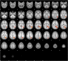 FIGURE 3. Regression map (stories > tones activation) with StimQ-P Reading subscale score as explanatory variable. Regression map for the story listening task (stories > tones) in 3- to 5-year-old children (N = 19), with StimQ-P Reading score as explanatory variable. Cluster size 4087 voxels significant at P < .05 (FDR corrected), z score local maxima 3.25 to 3.44. Five-millimeter slices from z = –28 to z = 74 in MNI coordinate space. Color scale from t = 1.25 (cooler) to 4 (hotter). Radiologic orientation, left = right, right = left.