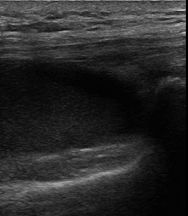 Ultrasound for knee effusion: lipohaemarthrosis and tibial plateau ...