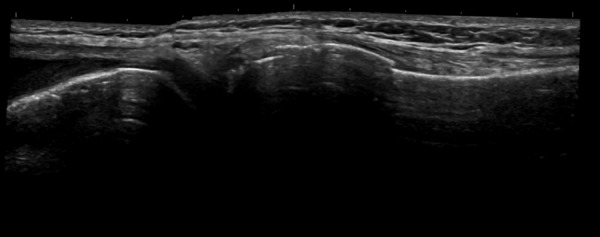 Ultrasound for knee effusion: lipohaemarthrosis and tibial plateau ...