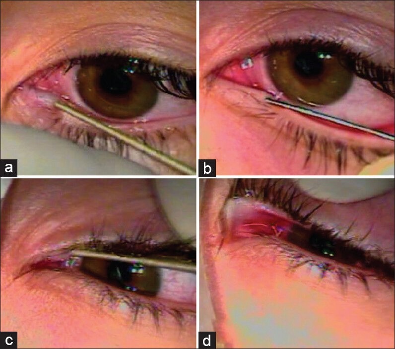 Lacrimal Outflow Mechanisms and the Role of Scintigraphy: Current ...