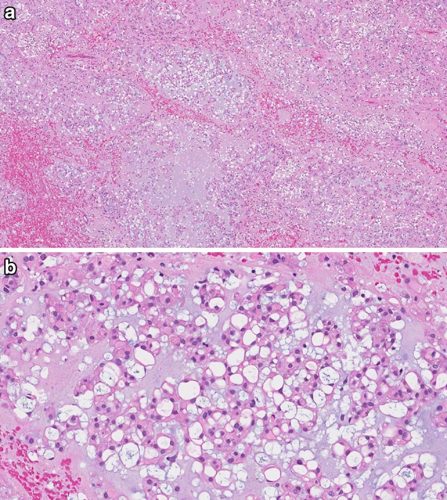 Chordoma of the Head and Neck: A Review - PMC