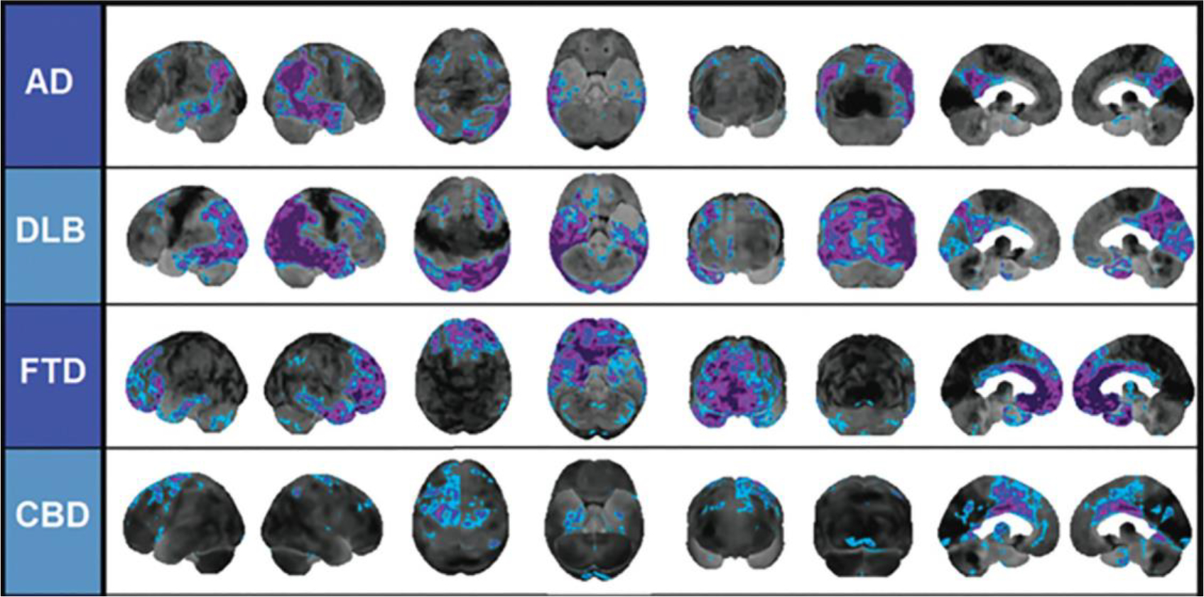 Brain PET Imaging Frontotemporal Dementia - PMC