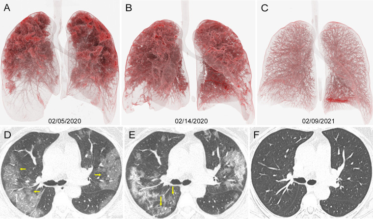 Images in 55-year-old woman diagnosed with severe COVID-19 with oxygen saturation of 73% at presentation. A–C, Cinematic renderings with, D–F, original CT scans help show evolution of her infection. A, D, Admission CT scans show confluent ground-glass opacities in both lungs (arrows in D), primarily distributed in upper lobes. B, E, CT scans 9 days later show progressive disease in lower lobes (arrows in E). C, F, Follow-up CT scans 1 year later show resolution of all previously seen lung findings.