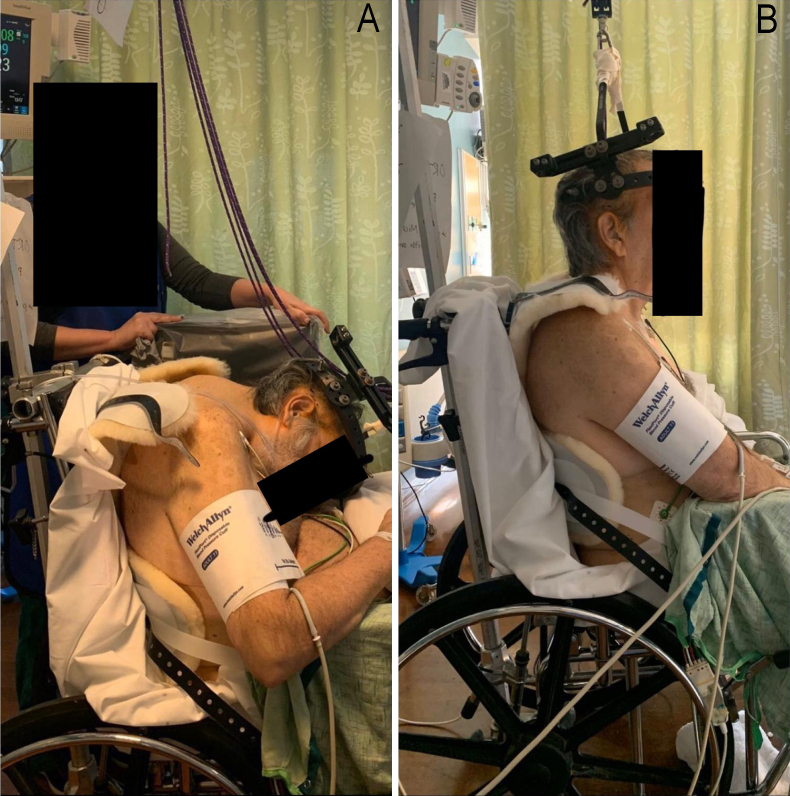 Management of atraumatic chin-on-chest deformity in newly diagnosed ...