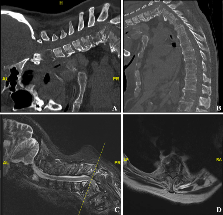 Management of atraumatic chin-on-chest deformity in newly diagnosed ...