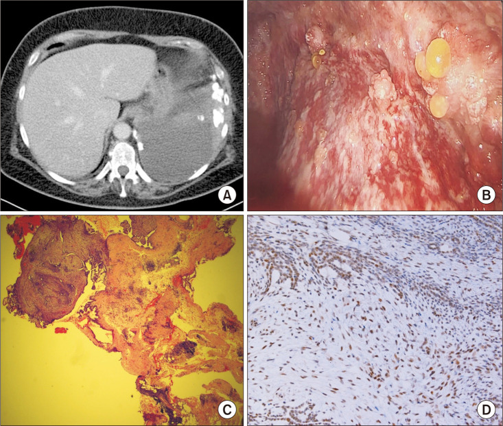 Well-Differentiated Papillary Mesothelial Tumor: An Unusual Radiologic ...