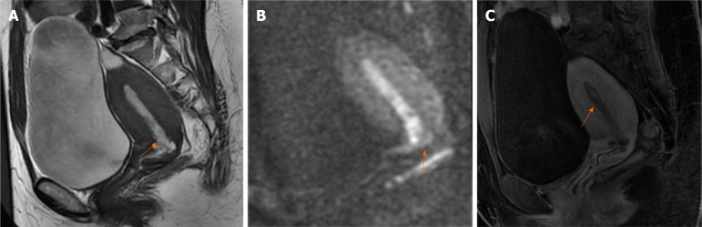 Endometrial carcinoma with cervical stromal invasion: Three case ...