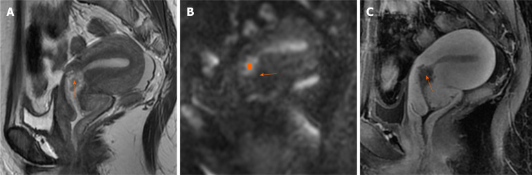 Endometrial carcinoma with cervical stromal invasion: Three case ...