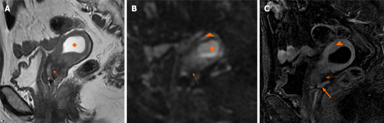 Endometrial carcinoma with cervical stromal invasion: Three case ...