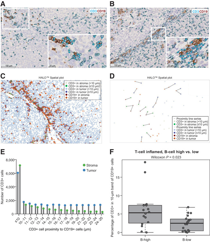 Figure 4. Tumor and stroma T- and B-cell interactions. Lymphocyte aggregates observed by dual CD3/CD19 IHC staining in a representative pretherapeutic tumor sample from a patient in COMBI-v with a high T-cell/high B-cell signature. This is the same representative field of view shown in Supplementary Fig. S1. Tumor (A) and stroma (B) compartments with CD3-positive T cells (light blue) and CD19-positive B cells (brown) with connected bands representing spatial proximity distribution. Digital (C), spatial (D), and proximity (E) analysis of T- and B-cell interactions that occurred at a distance of ≤10 and >10 μm, respectively. (F) T- and B-cell interactions in tumor and stroma compartments combined in samples from COMBI-v with high T-cell levels based on gene expression subgroups (n = 36). A box plot shows median with interquartile range (P value was determined by two-sided Wilcoxon signed-rank test).