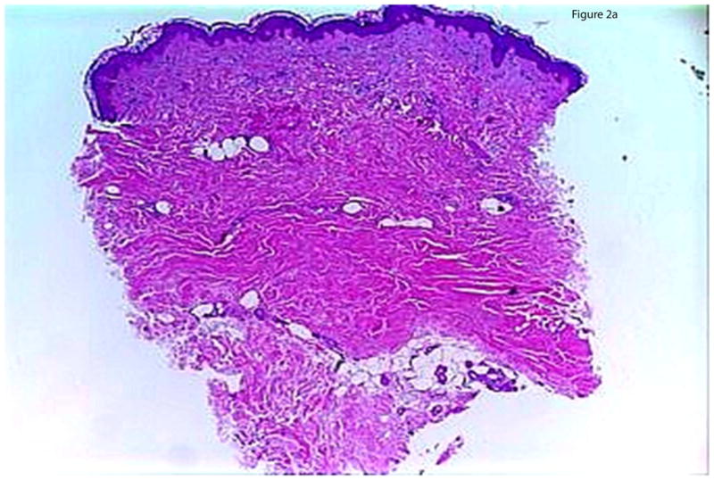 Histopathological changes in morphea and their clinical correlates ...