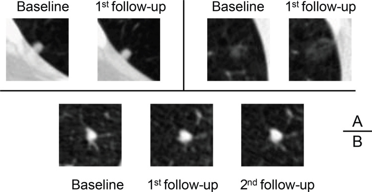 Axial low-dose CT images show examples of nodules without contrast media with different margins and internal characteristics classified by the serial-year radiomics-based reinforcement learning (S-RRL) model and the Brock model at baseline screening examination. (A) The S-RRL model correctly diagnosed three benign nodules as low risk (underwent 2 years of follow-up scans) (true negatives), while the Brock model mistakenly identified them as high or medium risk (false positives). (B) Three benign nodules were mistakenly identified as high risk (false positives) by both models. (C) Three malignant nodules were correctly diagnosed as high risk by the S-RRL model (true positives), but the Brock model diagnosed them as medium risk (false negatives). (D) Three malignant nodules were mistakenly identified as medium risk by both models (false negatives). GGO = ground-glass opacity.