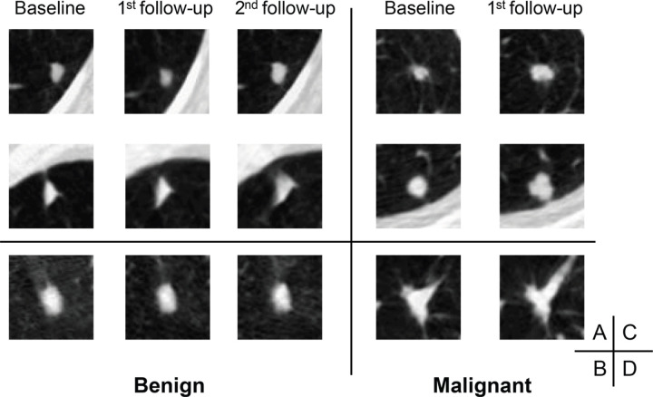 Axial low-dose CT images show examples of nodules without contrast media that were classified as Lung CT Screening Reporting and Data System (Lung-RADS) 3 or 4A by the serial-year radiomics-based reinforcement learning (S-RRL) model and the Brock model at the time of baseline examinations. (A) With the baseline scan, the S-RRL model correctly identified two benign nodules (underwent 2 years of follow-up scans) as low risk, while the Brock model identified them as medium risk. (B) A benign nodule was identified as medium and high risk by the S-RRL and Brock models, respectively. (C) Two malignant nodules were identified as high risk by the S-RRL model, but the Brock model identified them as low risk. (D) A malignant nodule was identified as medium risk by both models.