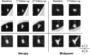 Axial low-dose CT images show examples of nodules without contrast
media that were classified as Lung CT Screening Reporting and Data System
(Lung-RADS) 3 or 4A by the serial-year radiomics-based reinforcement
learning (S-RRL) model and the Brock model at the time of baseline
examinations. (A) With the baseline scan, the S-RRL model correctly
identified two benign nodules (underwent 2 years of follow-up scans) as low
risk, while the Brock model identified them as medium risk. (B) A benign
nodule was identified as medium and high risk by the S-RRL and Brock models,
respectively. (C) Two malignant nodules were identified as high risk by the
S-RRL model, but the Brock model identified them as low risk. (D) A
malignant nodule was identified as medium risk by both models.