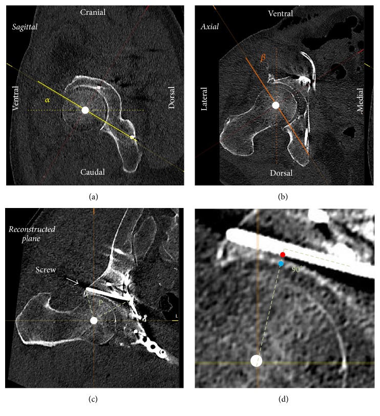 Secure Screw Placement in Management of Acetabular Fractures Using the ...