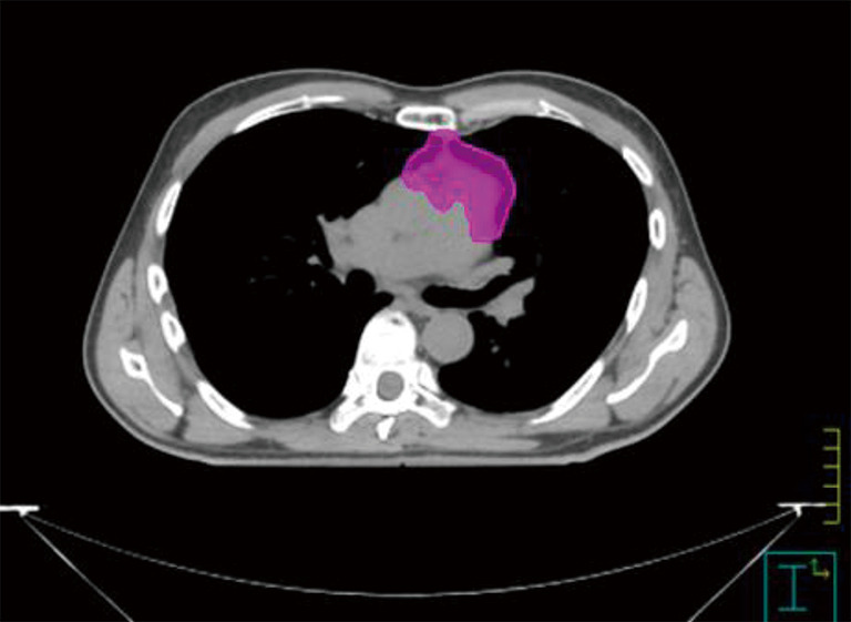 The role of postoperative radiotherapy for thymomas: a multicentric ...