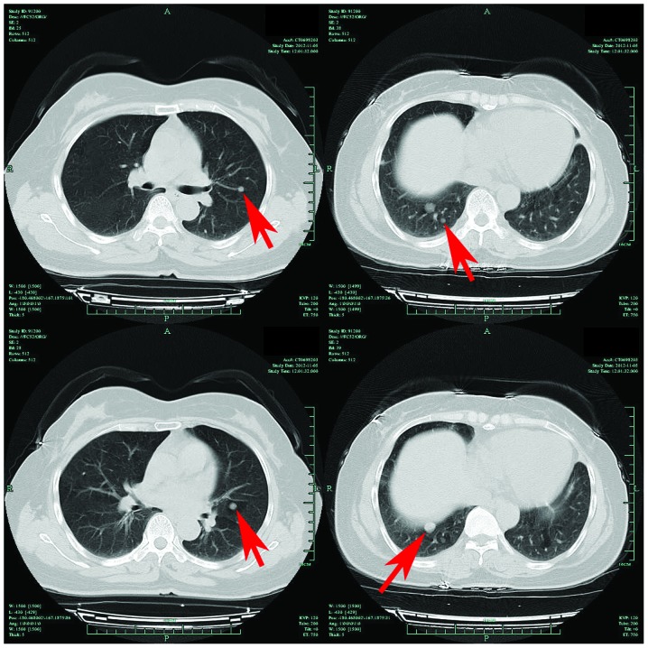 Pulmonary hamartoma resembling multiple metastases: A case report - PMC