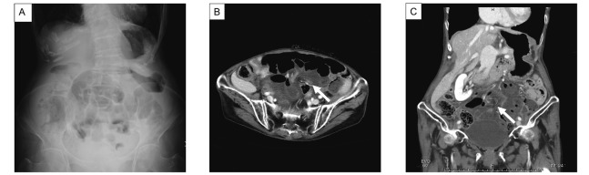 Ileo-ileal knot: a rare case of acute strangulated intestinal ...