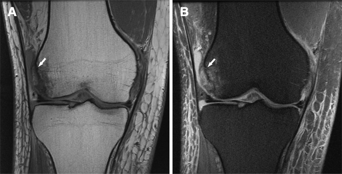 Recurrent patellar dislocation in a 34-year-old man after a fall. Coronal T1-weighted (A) and proton-density–weighted fat-suppressed (B) MR images show bone marrow edema-like signal intensity associated with an impaction fracture (arrow) of the lateral femoral condyle.