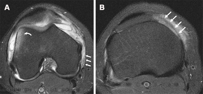 Acute lateral patellar dislocation in a 20-year-old woman. (A) Axial T2-weighted fat-suppressed MR image shows tearing of the posterior fibers of the MPFL (straight arrows) and a characteristic bone contusion (curved arrow) at the lateral aspect of the lateral femoral condyle. (B) Axial T2-weighted fat-suppressed MR image obtained further distally shows tearing of the MPML and MPTL (arrows).