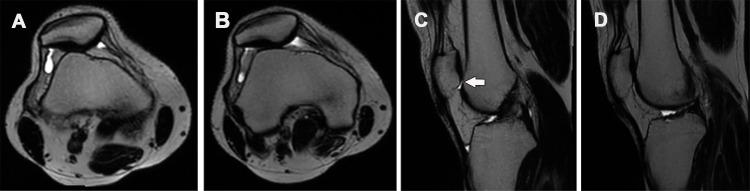 Patellar maltracking seen in a 39-year-old man at physical examination. Axial (A, B) and sagittal (C, D) T2-weighted single-shot fast spin-echo MR images were obtained with quadriceps contraction (A, C) and without quadriceps contraction during a routine static acquisition at rest (B, D). The images obtained with quadriceps contraction (A, C) show increased patellar height and increased lateral tilt, with loss of patellotrochlear cartilage overlap (arrow in C).