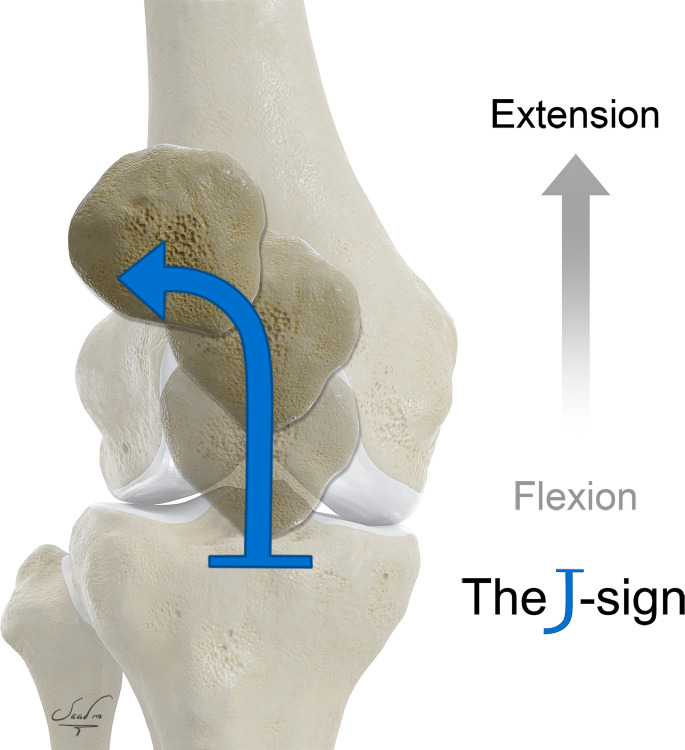 The J sign. This sign is a clinical finding that is indicative of patellar maltracking and is associated with patellofemoral pain syndrome. The J sign refers to an abnormal inverted J path that the patella takes with active knee extension from flexion in patients with patellar hypermobility.