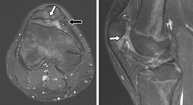 Hardware failure in a 17-year-old adolescent boy with mechanical symptoms and anterior knee pain 6 months after MPFL reconstruction. Axial (A) and sagittal (B) T2-weighted fat-suppressed MR images show a displaced screw (black arrow in A) at the posterior-medial aspect of the patella. There is deep chondral fissuring (white arrow) with underlying bone marrow edema-like signal intensity adjacent to the inferior drill tract that extends into the articular cortex of the medial patellar facet.