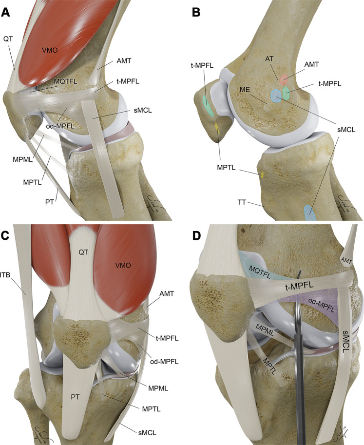 Three-dimensional (3D) illustrations show key osseous and soft-tissue structures of extensor mechanism in the lateral (A, B), anterior (C), and external oblique (D) perspectives, with respective osseous attachment areas. Structures of the medial patellofemoral ligament (MPFL) complex are exaggerated by the probe (in D). AMT = adductor magnus tendon, AT = adductor tubercle, ITB = iliotibial band, ME = medial epicondyle, od-MPFL = MPFL with oblique decussation component, t-MPFL = MPFL with transverse oblique decussation component, MPML = medial patellomeniscal ligament, MPTL = medial patellotibial ligament, MQTFL = medial quadriceps tendon femoral ligament, PT = patellar tendon, QT = quadriceps tendon, sMCL = superficial medial collateral ligament, TT = tibial tubercle, VMO = vastus medialis obliquus muscle.