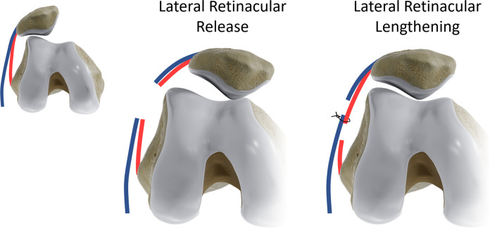 Lateral patellar retinacular release versus lengthening. Superficial (blue) and deep (red) layers of the lateral patellar retinaculum are schematically depicted. In the retinacular release procedure, which is frequently performed arthroscopically, both layers are transected in one plane. Full lateral release may cause iatrogenic medial patellar subluxation and instability. In retinacular lengthening, deep and superficial layers are isolated during an open surgery and transected at different levels to allow the patella to reduce and then are reapproximated to achieve appropriate tension and maintain integrity of the lateral retinaculum.