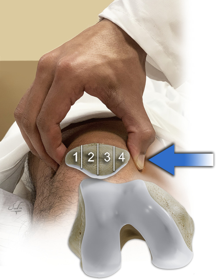 Patellar glide test. This test is used to evaluate passive patellar mobility, with the knee in full extension and in 30° flexion caused by the examiner pushing the patella medially and laterally. The examiner can palpate the projecting posterior surface of the patella and estimate the degree of patellar movement. The mobility is expressed in numbers of patellar quadrants (1–4) displaced from the starting position.