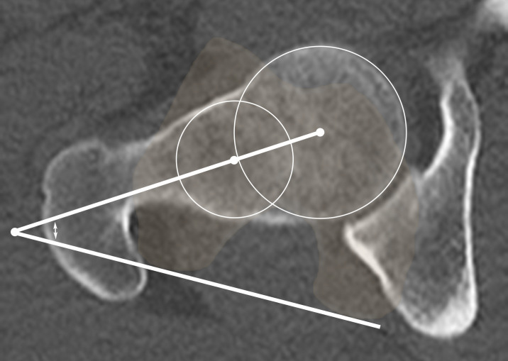 Measurement of femoral version. Axial CT image shows the femoral neck angle (double-headed arrow) measurement obtained by using 3D best-fit circles at the femoral head and femoral neck. The femoral version is determined by combining this measurement with the femoral bicondylar axis at the knee. Using 3D techniques for measurements can limit inter- and intraobserver error and improve accuracy.