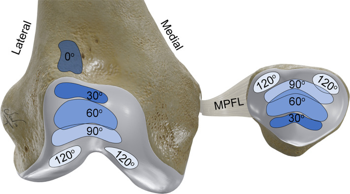 Patellofemoral contact areas. Normal contact areas between the patella and femoral trochlea vary at different angles of knee flexion. This results in variable contact force at the patellofemoral articulation in different degrees of flexion. In general, the contact pressure increases with increasing flexion angle degree.