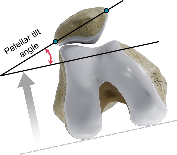 Patellar tilt angle. The patellar tilt angle is measured between the line through the medial and lateral patella at the greatest patellar width (blue dots) and a line parallel to the reference line tangent to the posterior borders of the femoral condyles (dashed line).